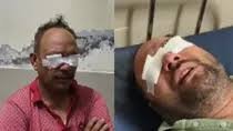 पंजाब में गंजेपन के इलाज के दौरान 20 लोगों की आँखों की गई रोशनी, हुआ ये एक्शन